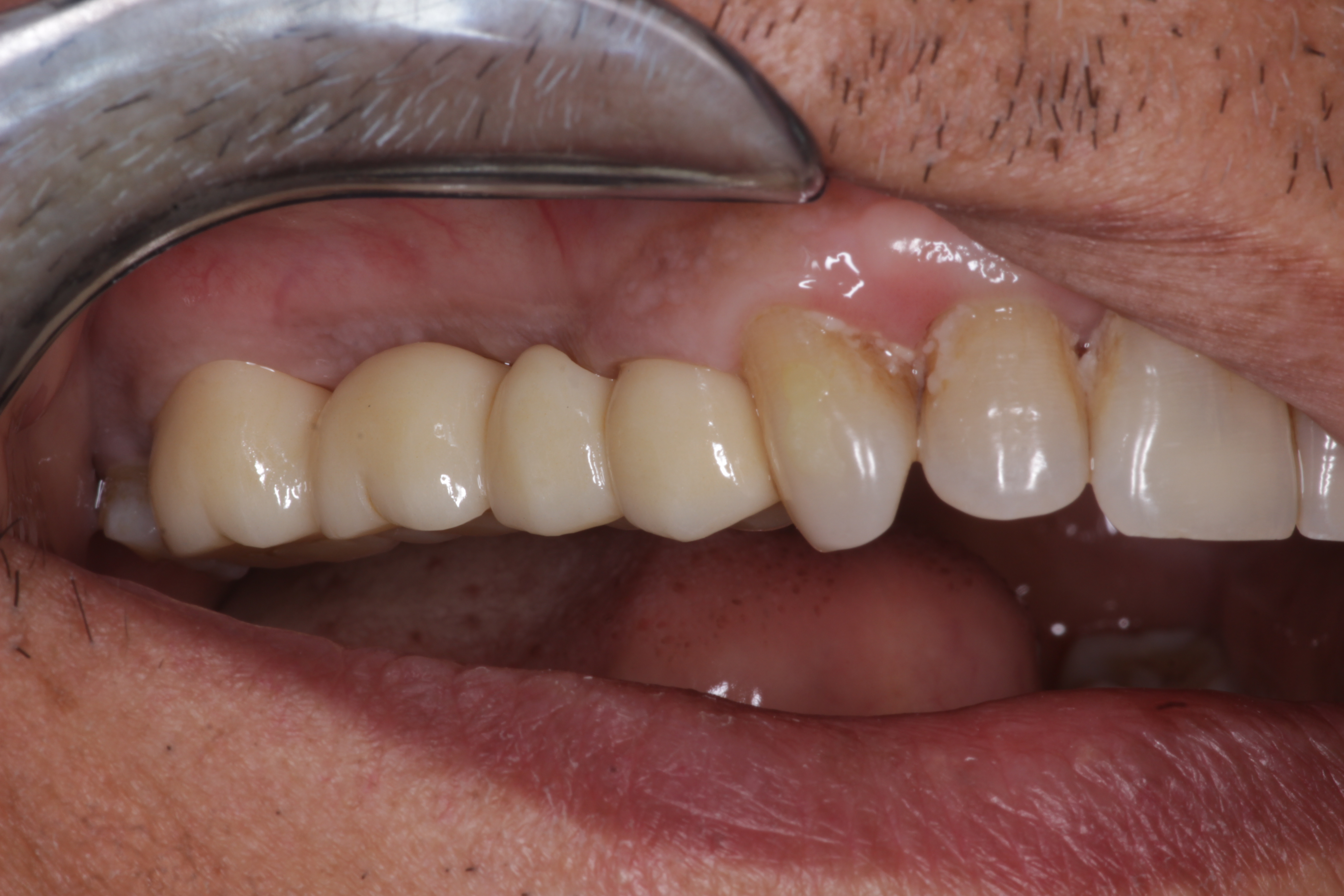 Crowns After
